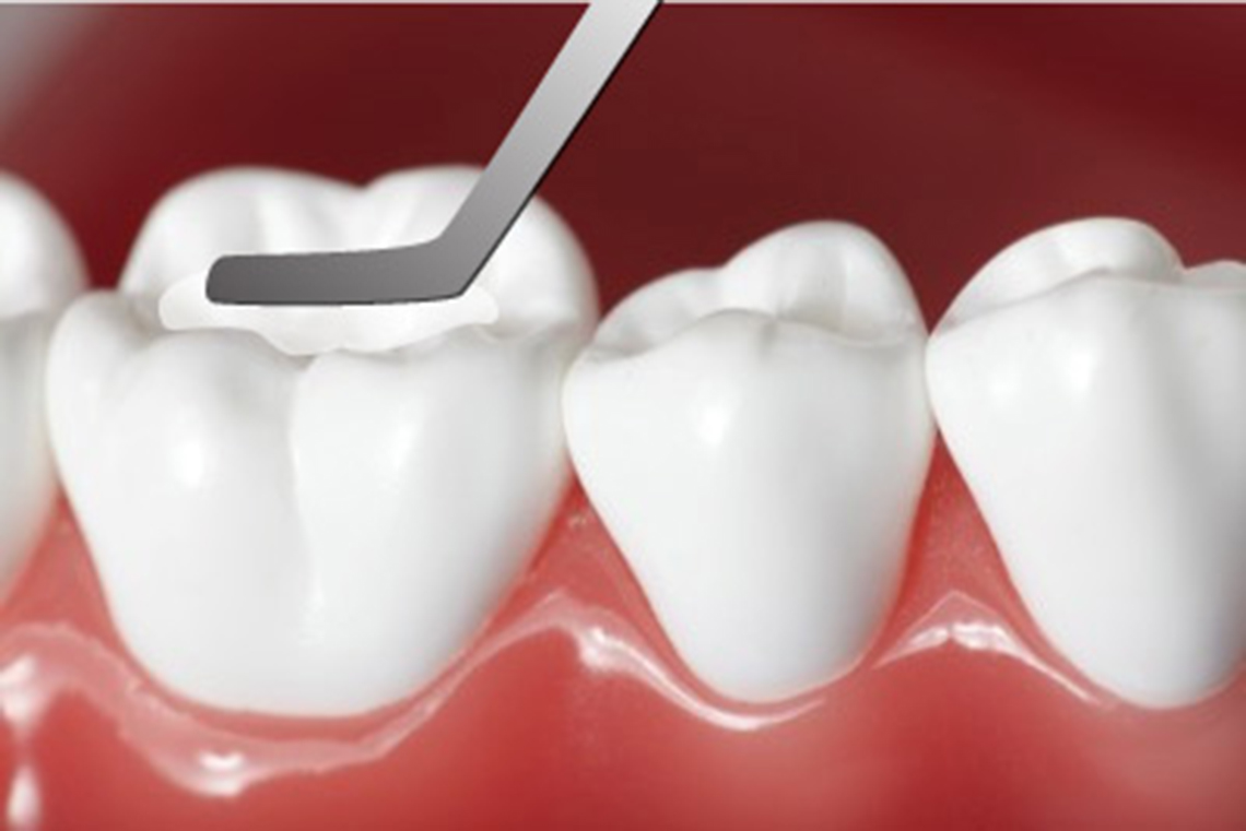 Trám răng Composite là gì? Trám răng Composite dùng được bao lâu mới hỏng?