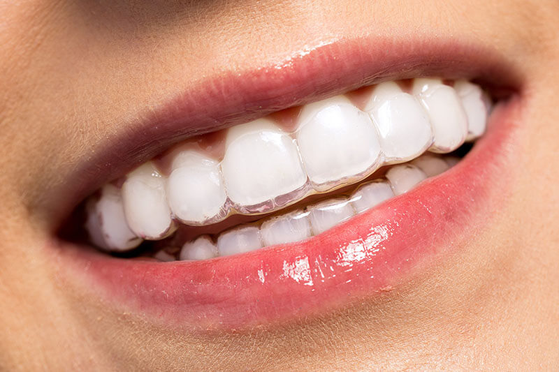 Những điều cần biết về niềng răng trong suốt - Omega Dental Hải Phòng