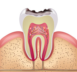 sâu răng